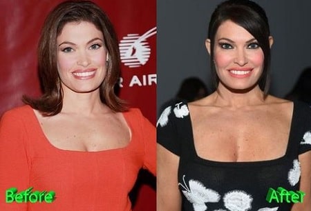Smile of Kimberly Guilfoyle before and after oral surgery.